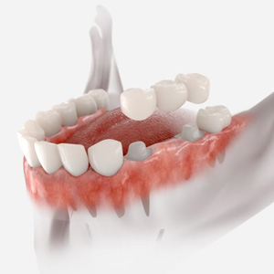 Illustration of traditional bridge being placed on prepared teeth
