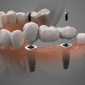 Illustration showing three-unit dental implant bridge