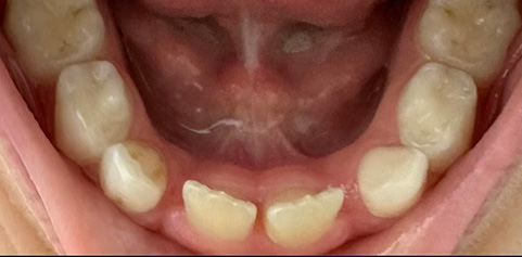 mile with missing tooth and bite restored