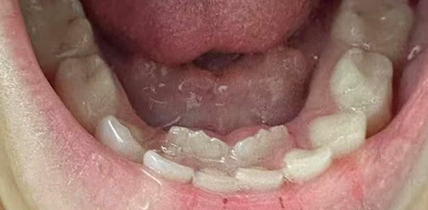 Missing front tooth and underbite