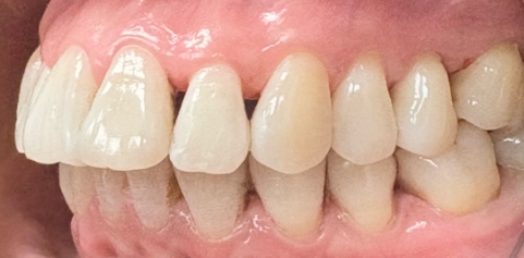 mile with missing tooth and bite restored