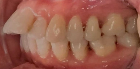 Missing front tooth and underbite