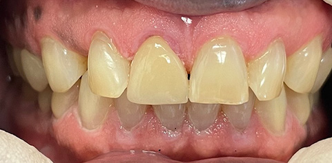 mile with missing tooth and bite restored