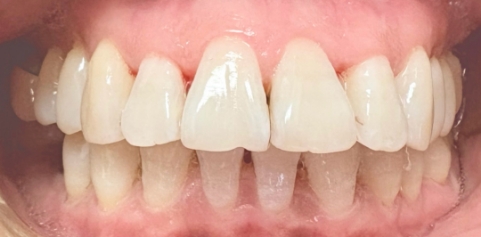 mile with missing tooth and bite restored