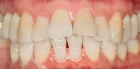 Missing front tooth and underbite