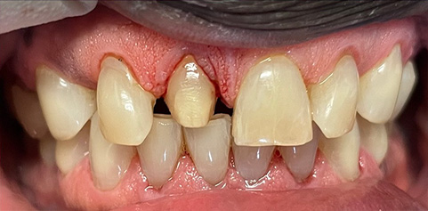 Missing front tooth and underbite