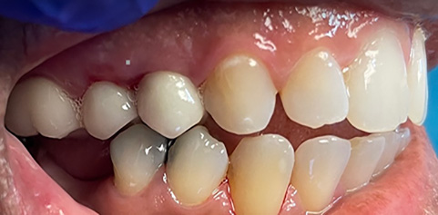 mile with missing tooth and bite restored