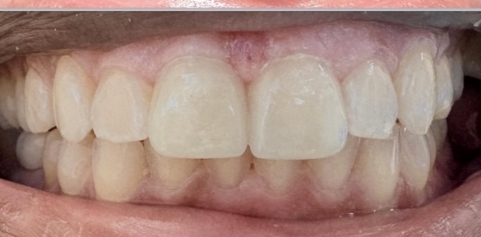 mile with missing tooth and bite restored