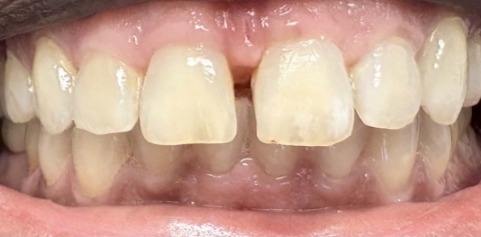 Missing front tooth and underbite