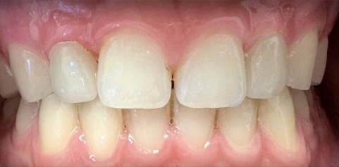 mile with missing tooth and bite restored
