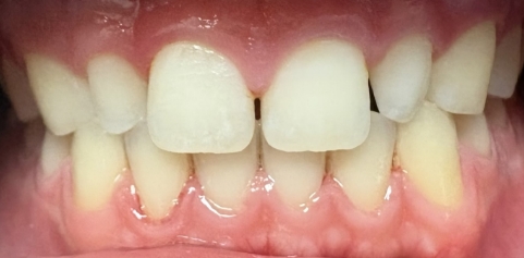 Missing front tooth and underbite