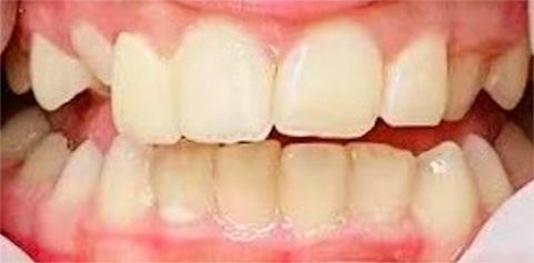 Close up of teeth after treatment
