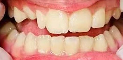Close up of teeth before treatment