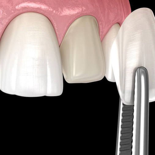Illustration of veneer being placed on tooth